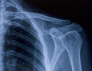 X-ray image of shoulder