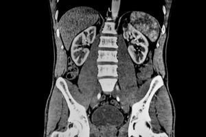 CAT SCAN of abdomen showing liver, kidney and the spine