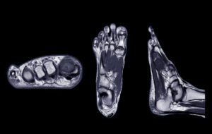 Magnetic resonance imaging of foot or MRI FOOT PDW axial, Coronal and sagittal view for diagnostic tendon injury.